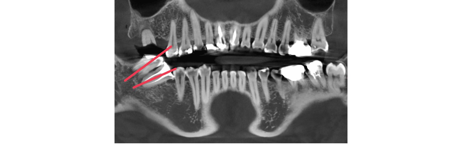 缺牙後未立即進行填補導致牙齒嚴重移位往前倒塌，出現咬合不正常