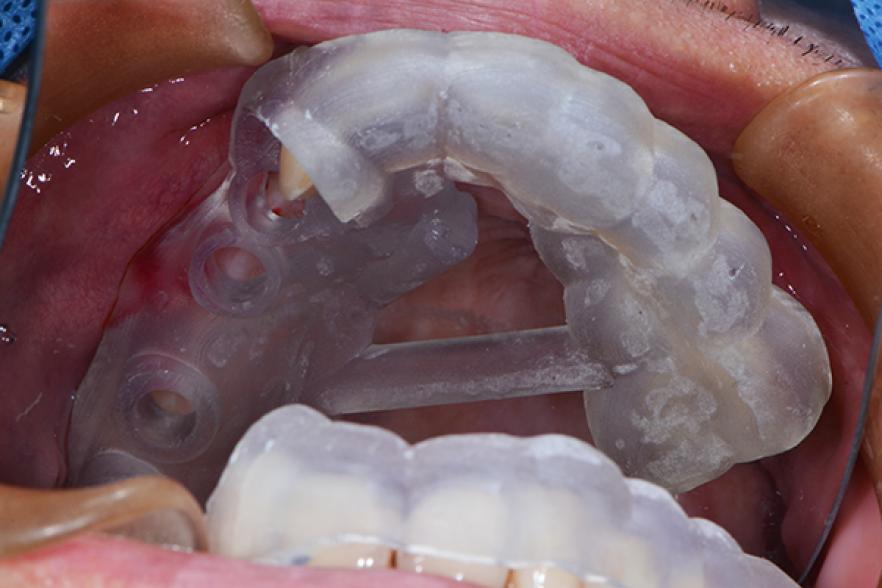 手術導板輔助植牙角度 精準定位提升成功率