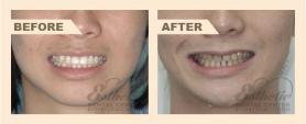 牙齒矯正 案例 G