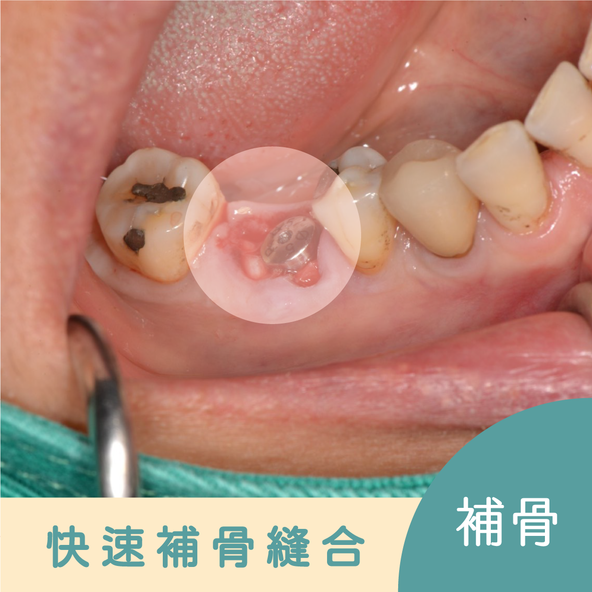 30分鐘微創導板植牙 傳統植牙 植牙補骨 安全快速 傷口不腫脹 精準規劃