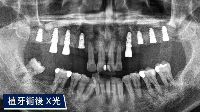術後牙齒X光