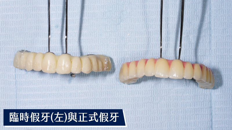 臨時假牙與正式假牙