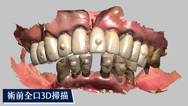 上顎術前3D掃描