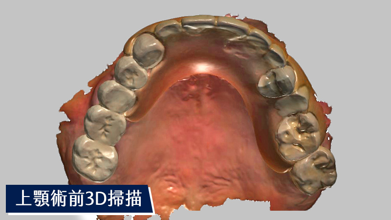 上顎術前3D掃描
