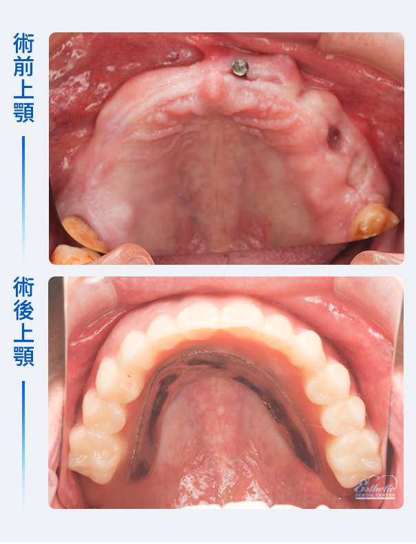 權泓牙醫Locator鈕扣式假牙案例分享
