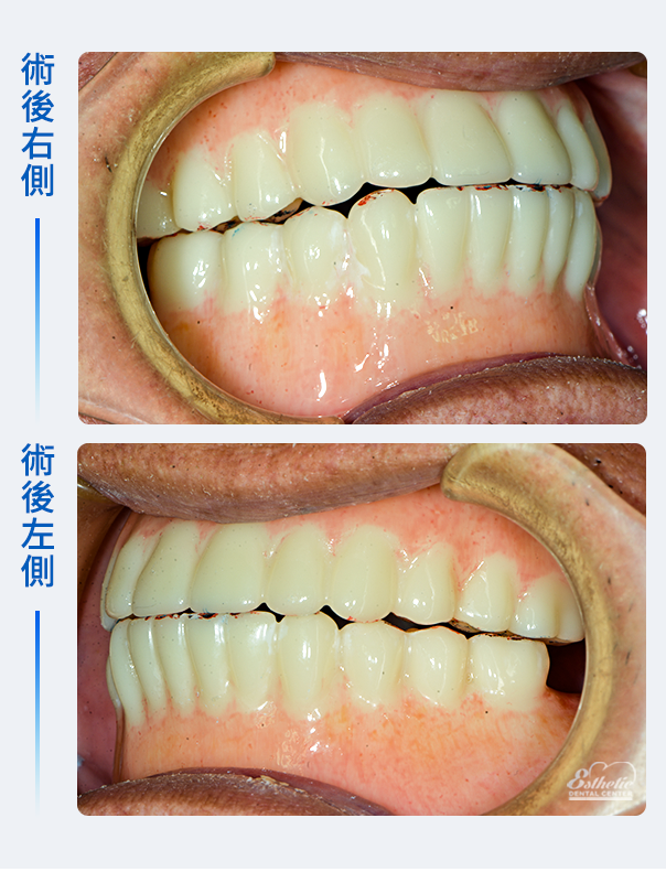 權泓牙醫Locator鈕扣式假牙案例分享