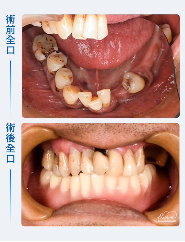 權泓牙醫Locator鈕扣式假牙案例分享