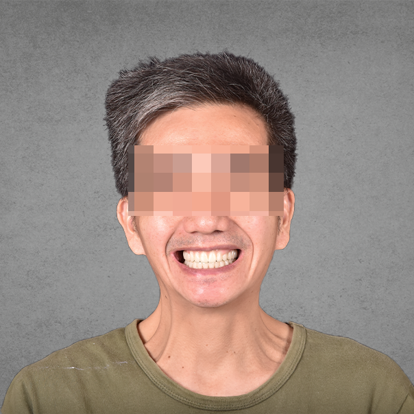 權泓牙醫Locator鈕扣式假牙案例分享