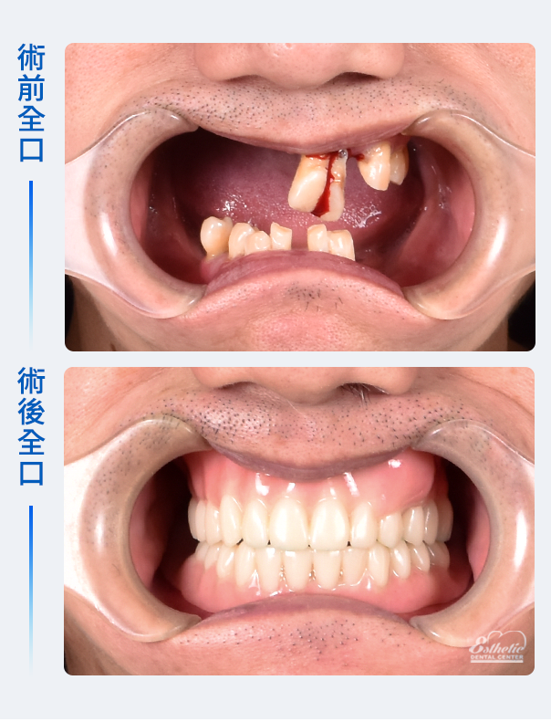 權泓牙醫Locator鈕扣式假牙案例分享