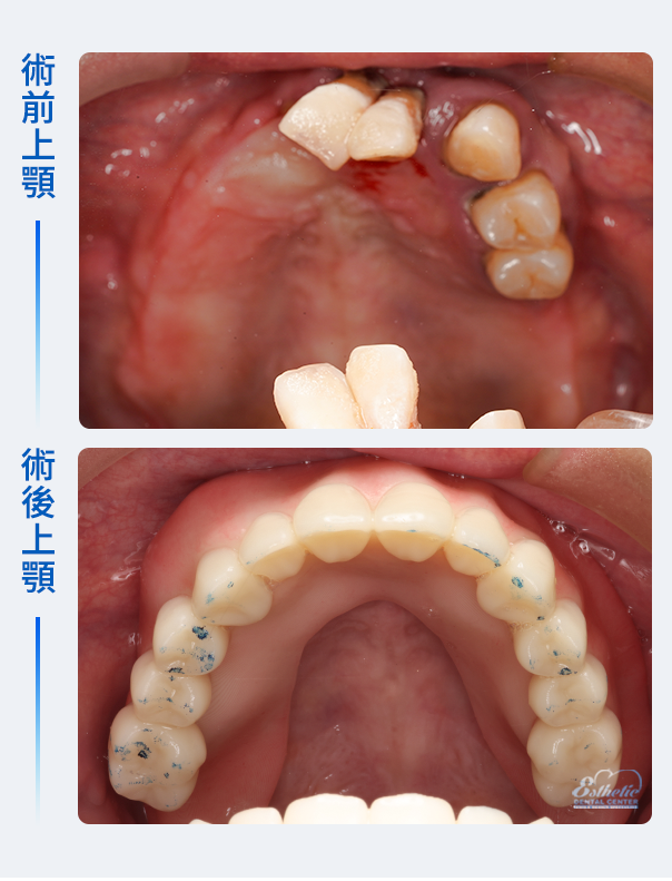 權泓牙醫Locator鈕扣式假牙案例分享