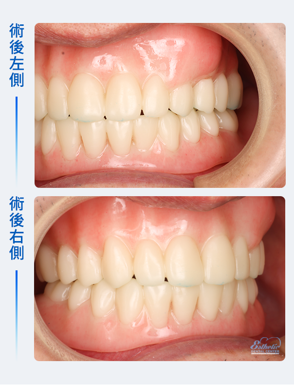 權泓牙醫Locator鈕扣式假牙案例分享