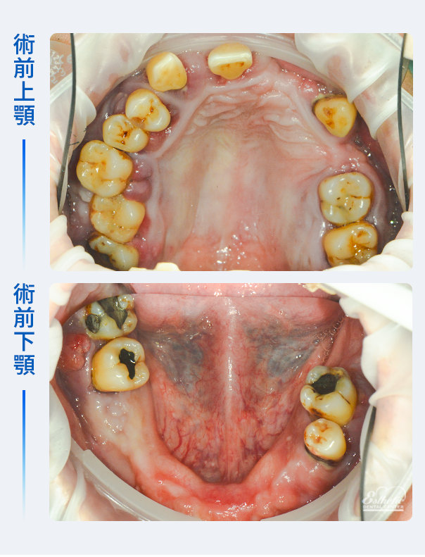 權泓牙醫Locator鈕扣式假牙案例分享