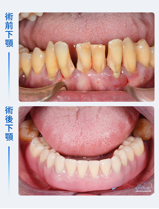 權泓牙醫Locator鈕扣式假牙案例分享