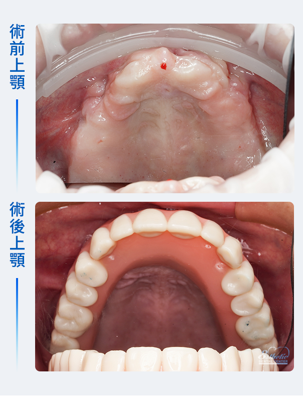 權泓牙醫Locator鈕扣式假牙案例分享