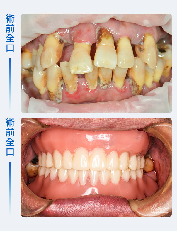 權泓牙醫Locator鈕扣式假牙案例分享