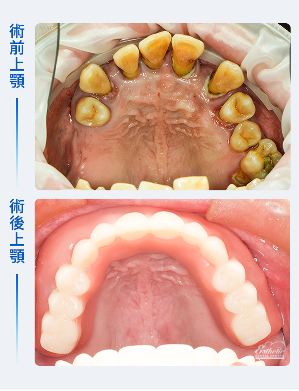 權泓牙醫Locator鈕扣式假牙案例分享
