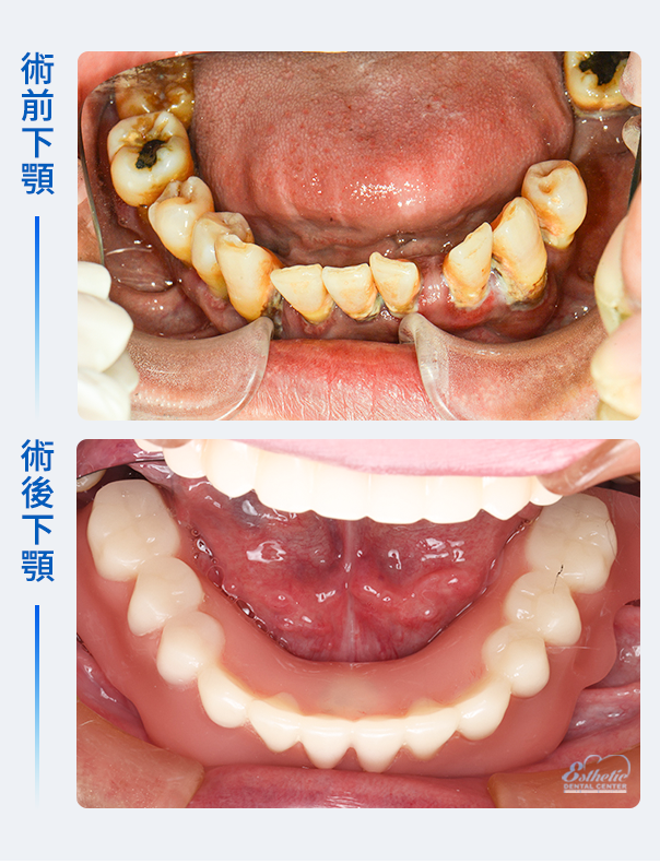 權泓牙醫Locator鈕扣式假牙案例分享