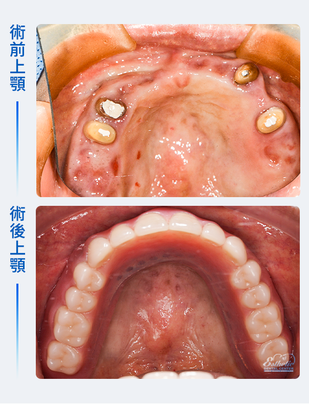 權泓牙醫Locator鈕扣式假牙案例分享