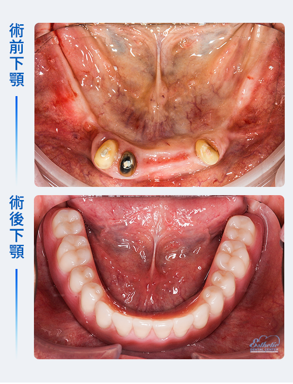 權泓牙醫Locator鈕扣式假牙案例分享