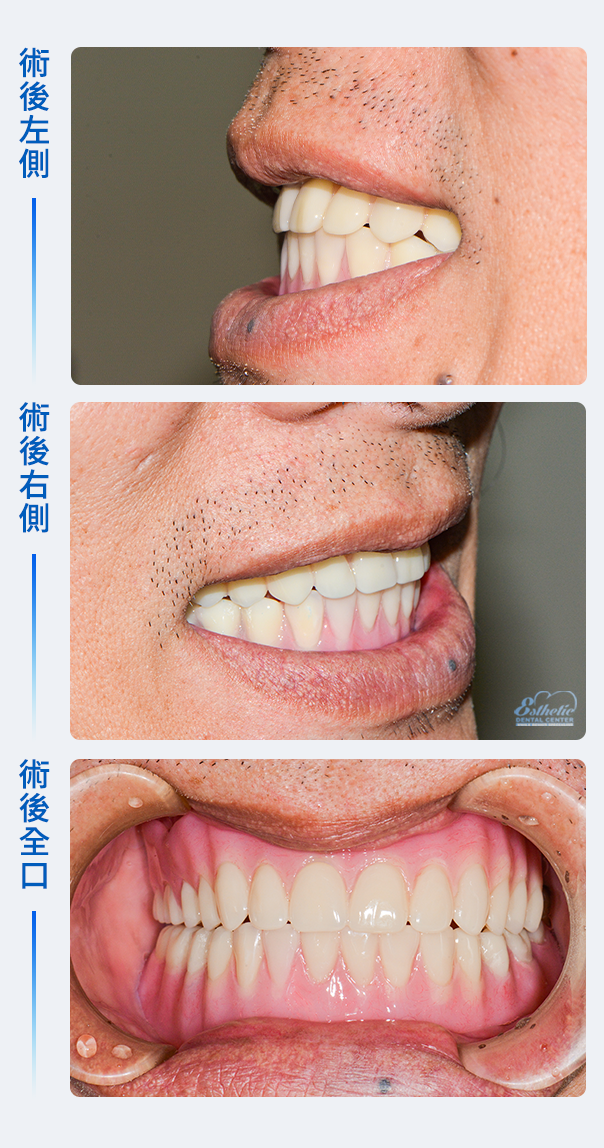 權泓牙醫Locator鈕扣式假牙案例分享