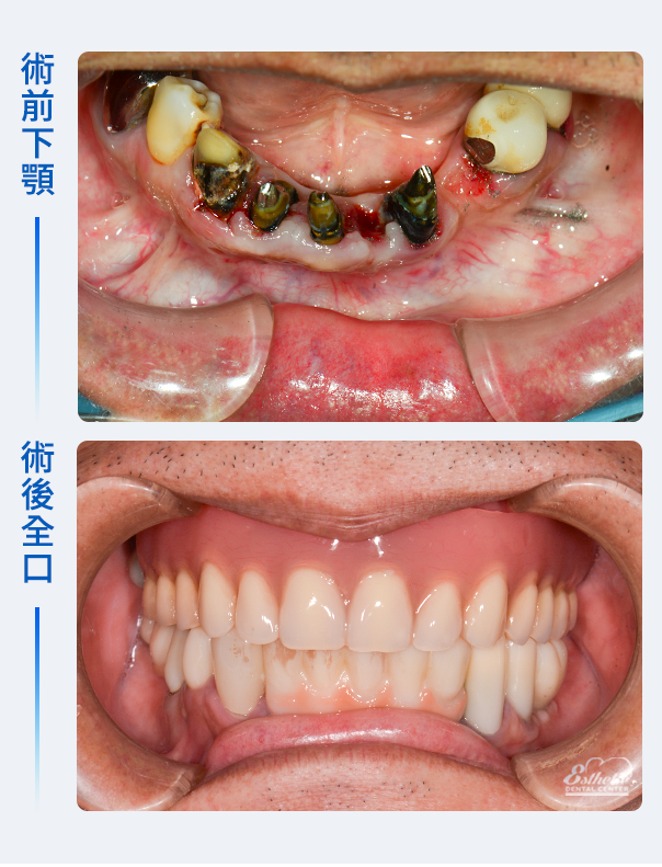 權泓牙醫Locator鈕扣式假牙案例分享